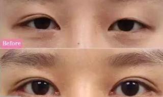 眼睑下垂该怎么办 眼皮下垂解决方法